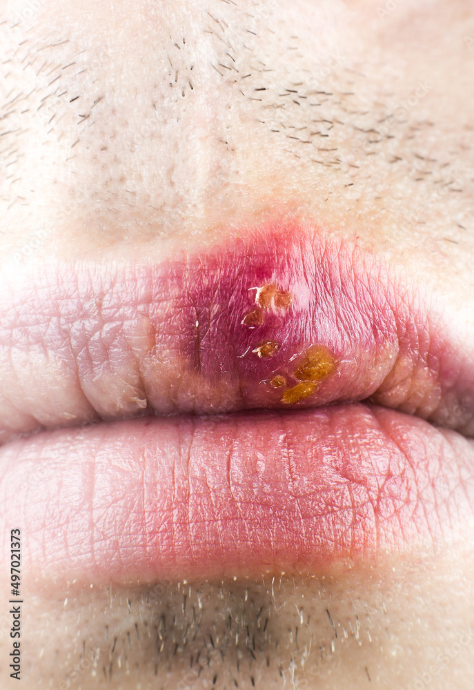 Fototapeta premium Herpes labialis on the lip of a Caucasian man. Face close-up..Сold sores illness disease. Simplex virus.