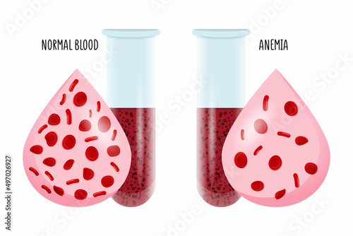 The difference of Anemia amount of red blood cell and normal. Illustration about medical.