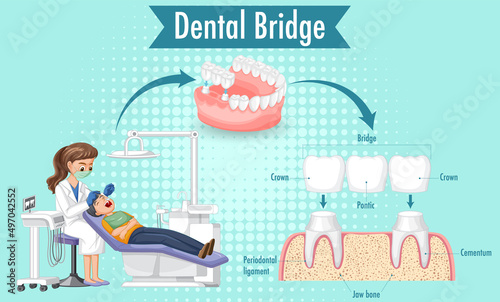 Infographic of human in dental bridge