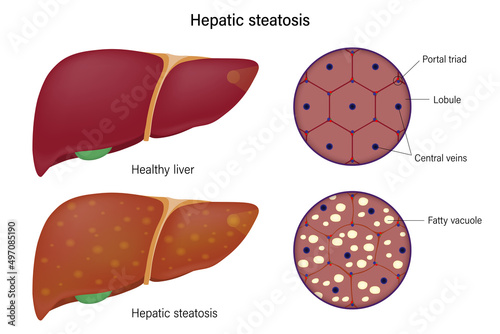 Liver histology. Normal liver and hepatic steatosis. Liver disease for medical education and science.