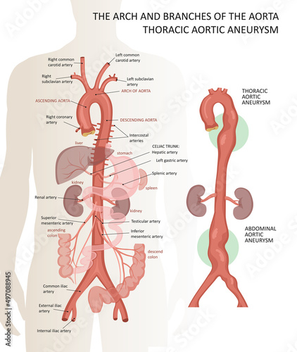 The arch and branches of the aorta. Thoracic aortic aneurysm photo