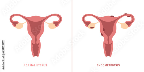 endometriosis and normal uterus womens health anatomy info graphic photo