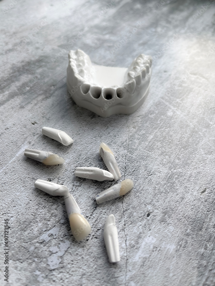 Plaster model from Geller with veneers in disassembled form. Production