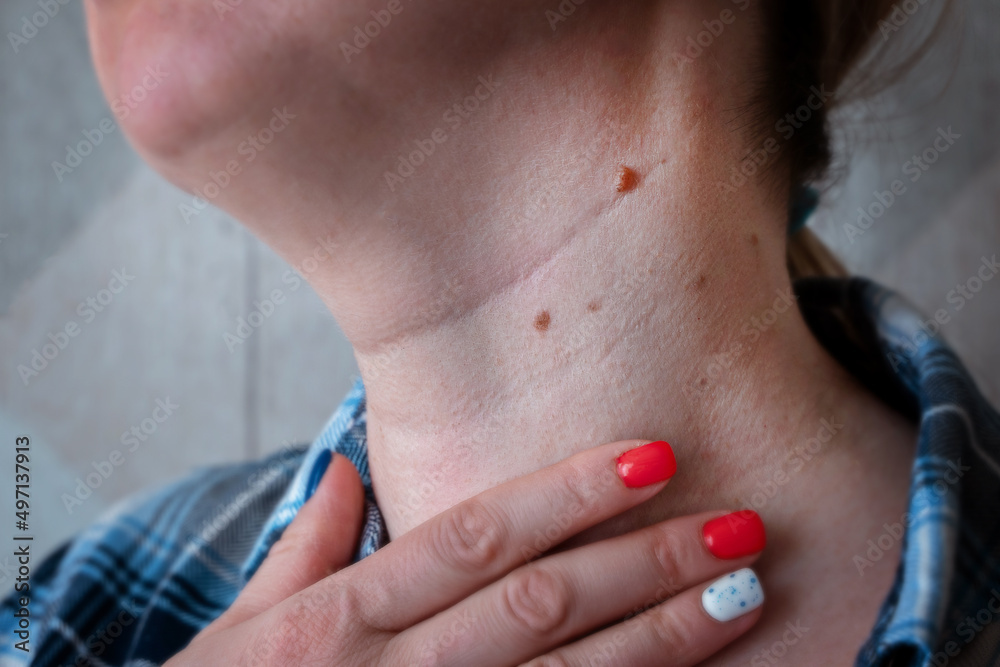 a woman shows moles on her neck a woman shows moles on her neck