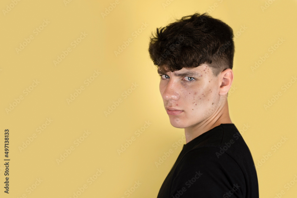The teenage boy with pimples and acne on his face, the boy is sad because he is ashamed of his peers, and suffers from the pain of acne. The concept of unhealthy skin in a teenager The teenage boy with pimples and acne on his face, the boy is sad because he is ashamed of his peers, and suffers from the pain of acne. The concept of unhealthy skin in a teenager