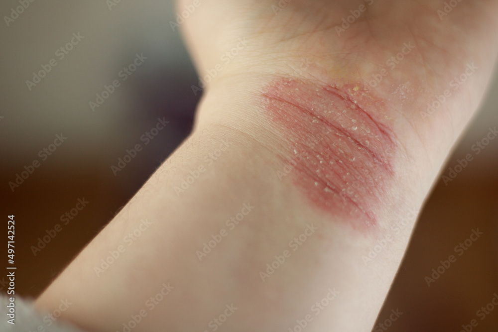 A physical of Atopic dermatitis (AD), also known as atopic eczema, is a type of inflammation of the skin (dermatitis) A physical of Atopic dermatitis (AD), also known as atopic eczema, is a type of inflammation of the skin (dermatitis)