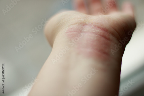 atopic dermatitis symptom skin on hand photo