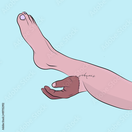 Surgery to save tissue, hand grafted on the leg.