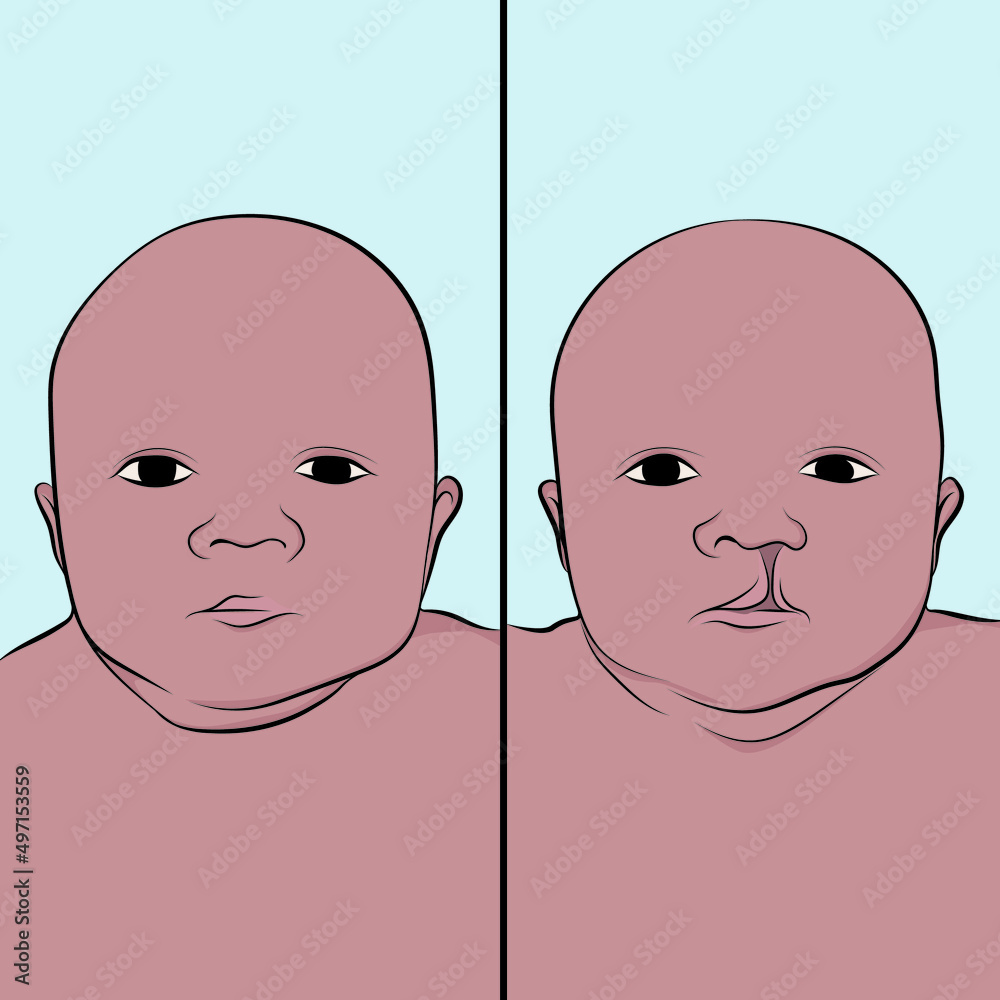 Cleft lip and palate syndrome, cleft lip, or cleft lip to the congenital defect that consists of