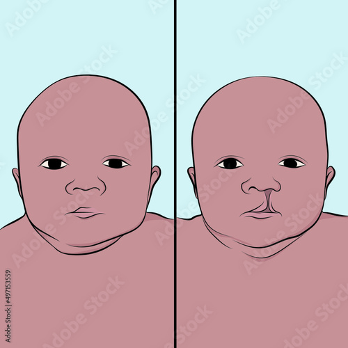 Cleft lip and palate syndrome, cleft lip, or cleft lip to the congenital defect that consists of a cleft or separation in the upper lip.