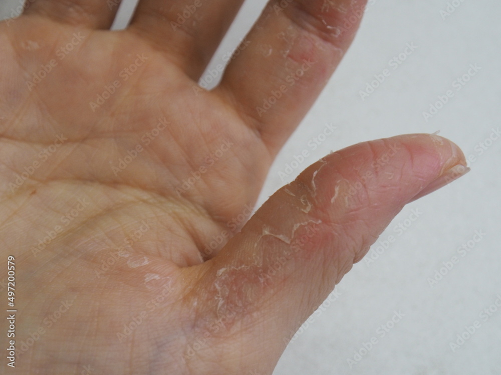 peeling hand skin on focus background peeling hand skin on focus background