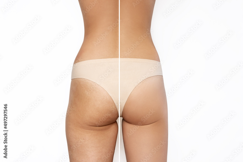 Female buttocks before and after liposuction or anti-cellulite treatment on a white background. Getting rid of excess weight, diet, proper nutrition, training, sports, massage, scrub. Health care Female buttocks before and after liposuction or anti-cellulite treatment on a white background. Getting rid of excess weight, diet, proper nutrition, training, sports, massage, scrub. Health care