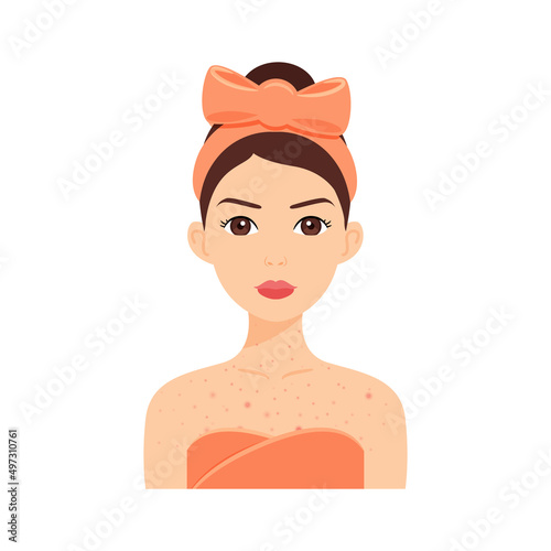 Beautiful Woman with Acne on Chest and Neck. Skin Problems on Breast. Inflammation and Red Pimples. Portrait of Adult Young Girl. Color Cartoon style. White background. Vector image for Medical design