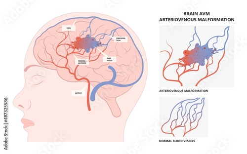 swelling artery veins capillaries system scalp brain ct scan X-ray image mri diagnose Blood AVM flow stroke Loss of optic nerve pain head galen tangle nidus cerebral attack Transient dural fistula
