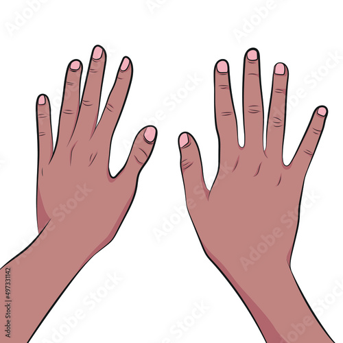 Hands with Marfan syndrome affects the heart, eyes, blood vessels, bones, and disproportionate limbs. photo