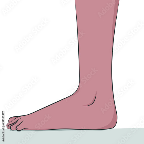 Flatfoot, a condition in which the entire sole of the foot touches the floor when standing.