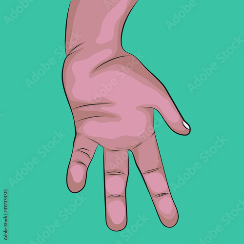 One of the most frequent congenital differences of the hand, the lack of the thumb or hypoplasia.