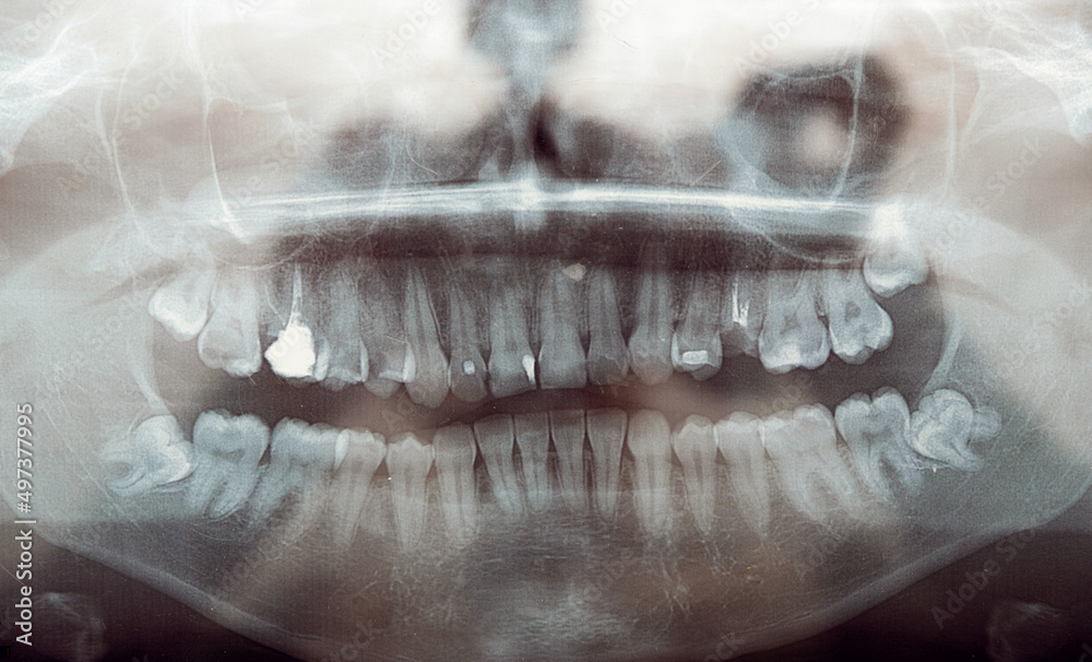 Obraz premium panoramic x-ray of teeth. problem teeth. dental clinic. close-up.treatment of diseased teeth.