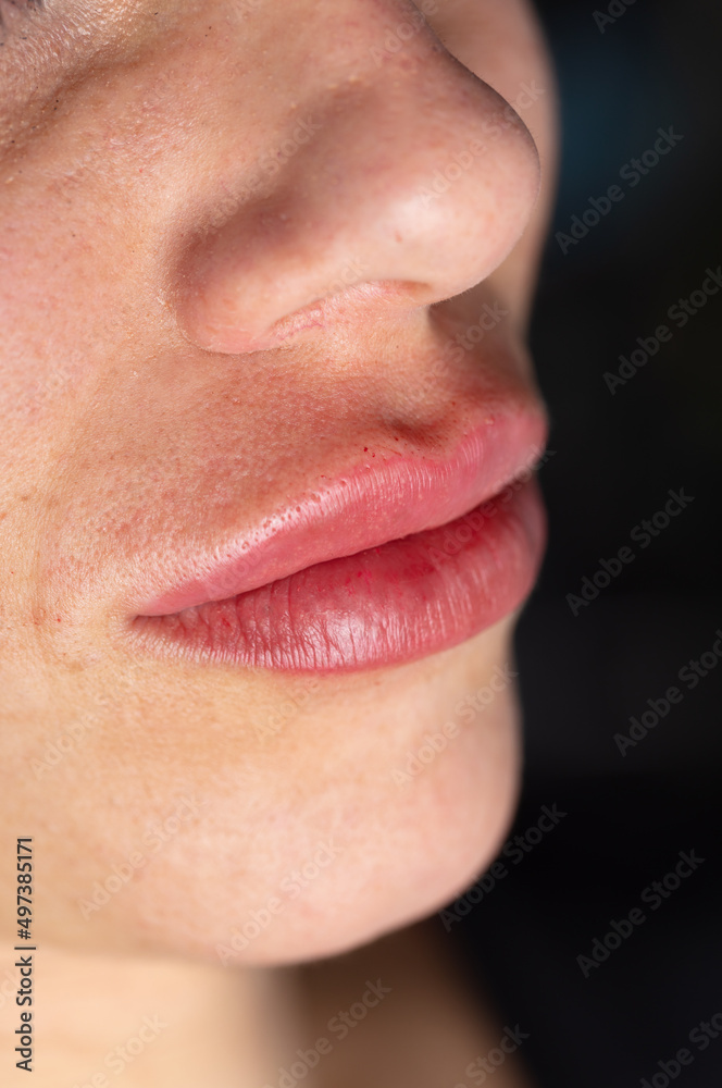Obraz premium Young lady getting injections for bigger, fuller lips. The woman in the beauty salon. Plastic surgery clinic. 