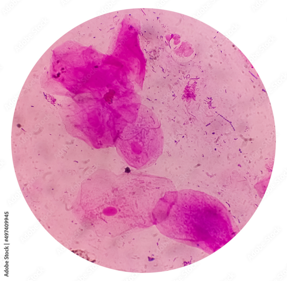 gram negative rods and gram positive cocci