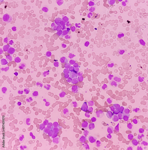 Chronic myeloid leukemia(CML) is a type of blood cancer. show the increased and unregulated growth of myeloid cells, mononuclear cells in blood smear. photo