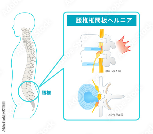 椎間板ヘルニアの図解イラスト