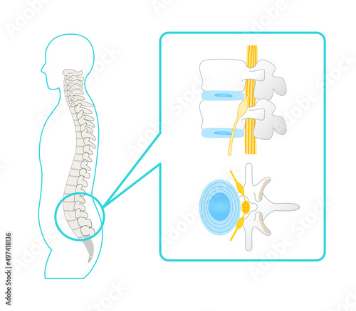 Illustration of a healthy lumbar spine Vertebrae and sciatic nerve