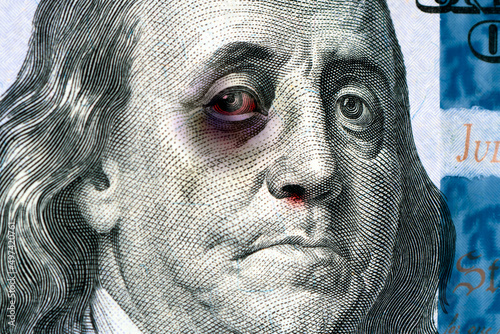 Benjamin Franklin on a 100 us bill with a black eye. The concept of the economic crisis in United States. Inflation dollar. Refusal of international dollar settlements photo