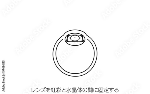 ICL（眼内コンタクトレンズ）手術、ICL固定の図解