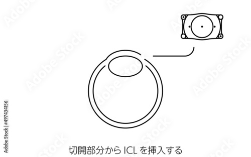 ICL（眼内コンタクトレンズ）手術、ICL挿入の図解