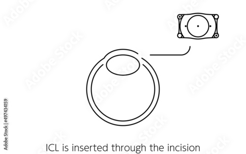 ICL（眼内コンタクトレンズ）手術、ICL挿入の図解