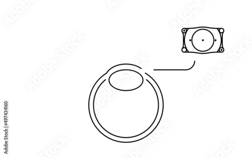 ICL（眼内コンタクトレンズ）手術、ICL挿入の図解 photo