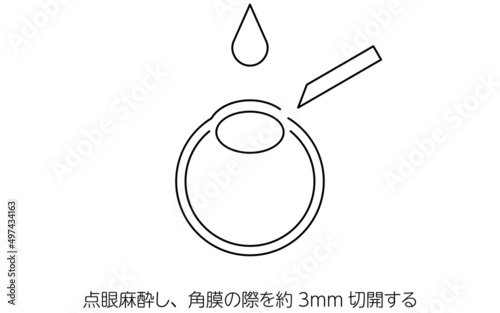 ICL（眼内コンタクトレンズ）手術、切開の図解