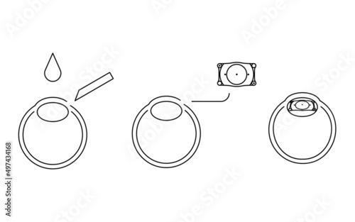 ICL（眼内コンタクトレンズ）手術、図解
