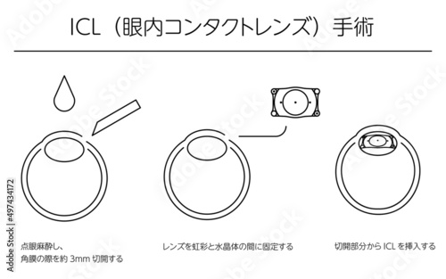 ICL（眼内コンタクトレンズ）手術、図解