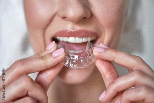 Close up of face of woman applying a transparent dental aligner
