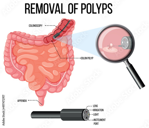 Diagram showing removal of polyps