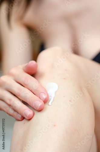 Open jar of cream in a female hand. Acne cream. Irritation after depilation.
