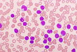 Picture of acute lymphocytic leukemia or ALL cells in blood smear, analyze by microscope, 1000x