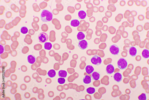 Picture of acute lymphocytic leukemia or ALL cells in blood smear, analyze by microscope, 1000x photo