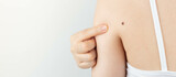 Young woman pointing at dark brown moles on her back for self-exams skin. Being aware of changes in your moles to detecting skin cancer, especially malignant melanoma. Skin disease concept.