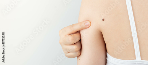 Photos Young woman pointing at dark brown moles on her back for self-exams skin