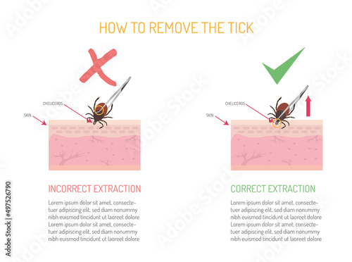 How to properly remove a tick