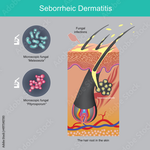Seborrheic Dermatitis. Scalp fall of sheets problem caused by sebaceous glands in hair roots skin and fungi on scalp..