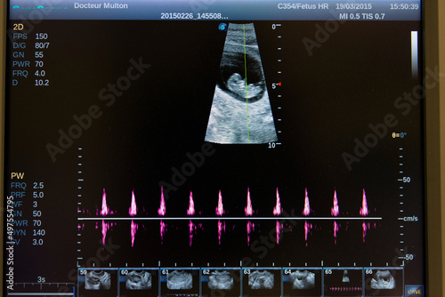Echographie d'une femme enceinte photo