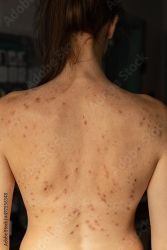 Acne problem concept. Teenage girl with problem skin on her back with pimples and rash photo