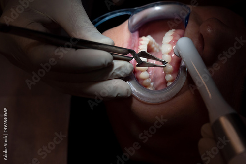 Crop dentists putting tooth filling to patient photo