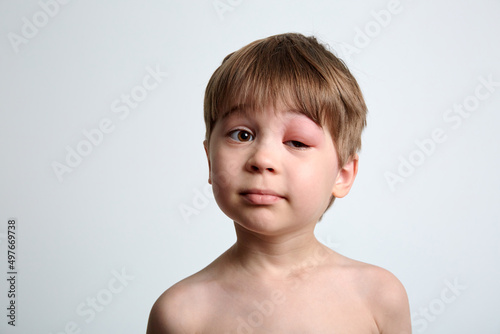 Obraz na plátně A boy with swollen eye from insect bite