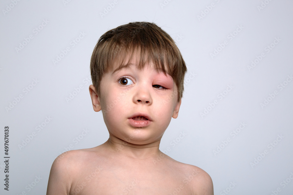 Child with red swollen eye from insect bite. Quincke edema. Portrait of unhappy caucasian appearance boy. Isolated background. Face of allergic person. Copy space. Studio. Allergy. Sick body part Child with red swollen eye from insect bite. Quincke edema. Portrait of unhappy caucasian appearance boy. Isolated background. Face of allergic person. Copy space. Studio. Allergy. Sick body part