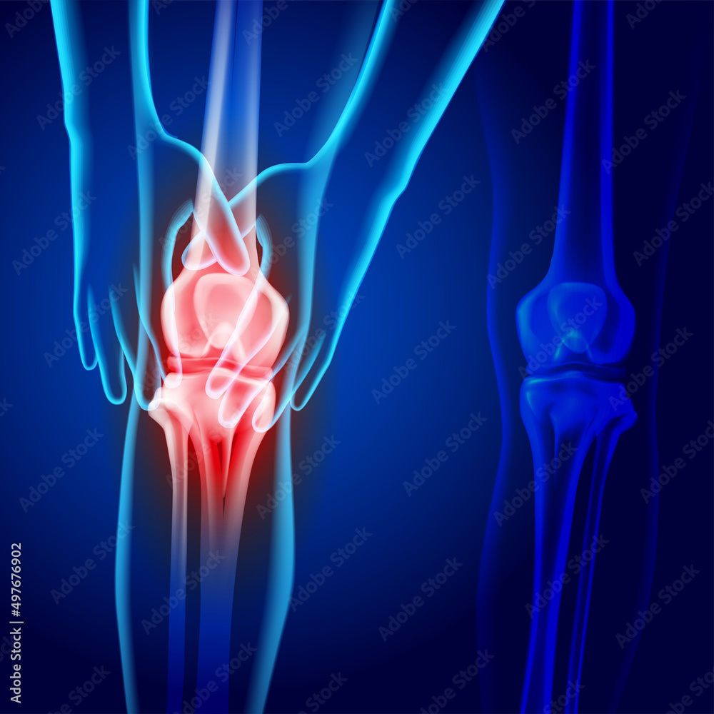 X-ray image of two hands holding knee showing knee joint injury on dark blue background. Used in medical and educational fields. X-ray image of two hands holding knee showing knee joint injury on dark blue background. Used in medical and educational fields.